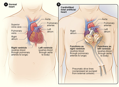 Figure A shows the normal structure and location of the heart. Figure B shows a CardioWest TAH. Tubes exit the body and connect to a machine that powers and controls how the CardioWest TAH works. 