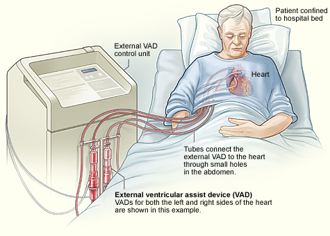 The image shows a transcutaneous BIVAD and how it's connected to the heart.