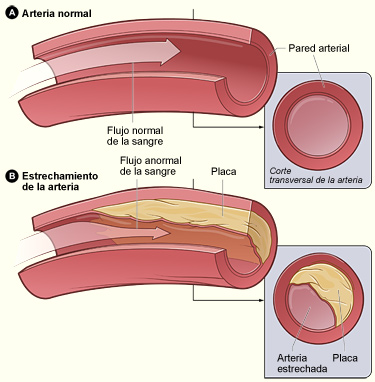 La figura A muestra una arteria normal por la que la sangre circula normalmente. En el recuadro se muestra un corte transversal de una arteria normal. La Figura B muestra una arteria con depósito de placa. En el recuadro se muestra un corte transversal de una arteria con depósito de placa.