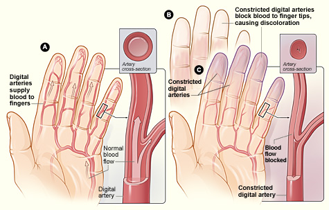 Figure A shows arteries in the fingers (digital arteries) with normal blood flow. The inset image shows a cross-section of a digital artery. Figure B shows fingertips that have turned white due to blocked blood flow. Figure C shows narrowed digital arteries, causing blocked blood flow and blue fingertips. The inset image shows a cross-section of a narrowed digital artery. 