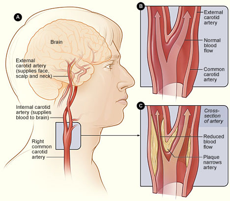 Figure A shows the location of the right carotid artery in the head and neck. Figure B is a cross-section of a normal carotid artery that has normal blood flow. Figure C shows a carotid artery that has plaque buildup and reduced blood flow.