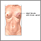 Breast reconstruction - series