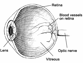 Drawing of a cross section of the eye with the retina, blood vessels on the retina, the optic nerve, the vitreous, and the lens labeled.
