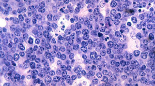 A pathology slide stained purple showing misshapen cells indicating malignant Burkitt lymphoma.