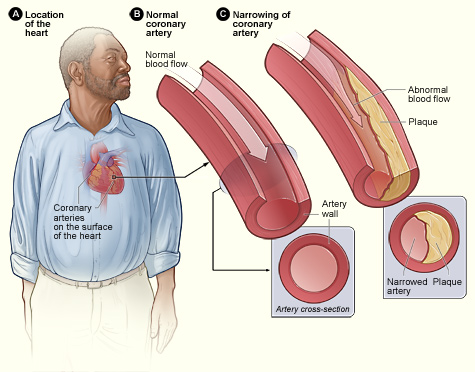 Figure A shows the location of the heart in the body. Figure B shows a normal coronary artery with normal blood flow. The inset image shows a cross-section of a normal coronary artery. Figure C shows a coronary artery narrowed by plaque. The buildup of plaque limits the flow of oxygen-rich blood through the artery. The inset image shows a cross-section of the plaque-narrowed artery.
