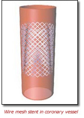 Wire mesh stent in coronary vessel