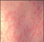 picture of measles