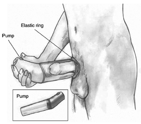 Drawing of a vacuum device placed around the penis to treat erectile dysfunction. Labels point to the pump, which draws air out of the cylinder, and an elastic ring, which, when fitted over the base of the penis, traps the blood and sustains the erection after the cylinder is removed. An inset shows the vacuum device when not in use.