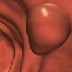 computer generated image of a colon polyp