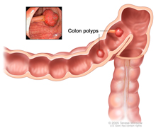 illustration of colon polyps.