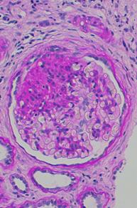 focal segmental glomerulosclerosis (FSGS)