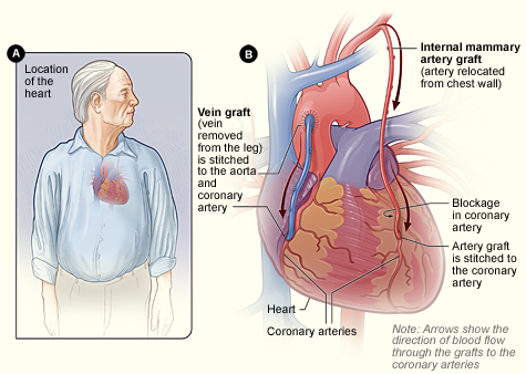 Figure A shows the location of the heart. Figure B shows how vein and artery bypass grafts are attached to the heart.