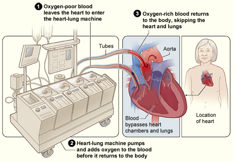 The image shows how a heart-lung bypass machine works during surgery. 