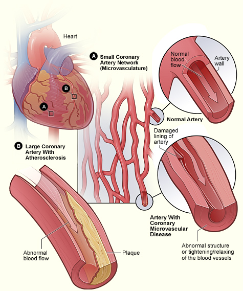 Figure A shows the small coronary artery network (microvasculature), containing a normal artery and an artery with coronary MVD. Figure B shows a large coronary artery with plaque buildup.  