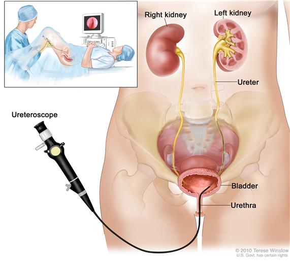 Ureteroscopy; drawing shows the lower pelvis containing the right and left kidneys, ureter, bladder, and urethra. The flexible tube of a ureterscope (a thin, tube-like instrument with a light and a lens for viewing) is shown passing through the urethra into the bladder and ureter. An inset shows a woman lying on an examination table with her knees bent and legs apart. She is covered by a drape. The doctor looks at a an image of the inside of the ureter on a computer monitor.