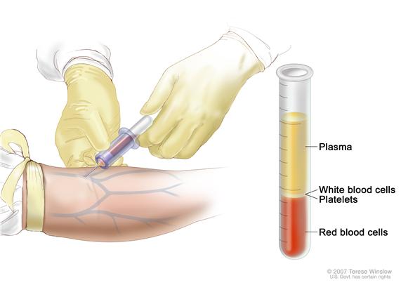 Complete blood count (CBC); left panel shows blood being drawn from a vein on the inside of the elbow using a tube attached to a syringe; right panel shows a laboratory test tube with blood cells separated into layers: plasma, white blood cells, platelets, and red blood cells.