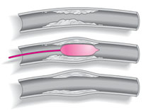 Minimally Invasive Treatments