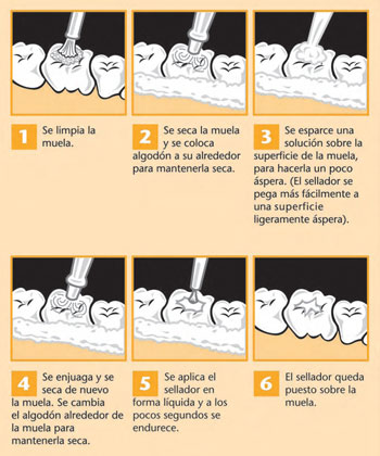 1. Se limpia la muela, 2.  Se seca la muela y se coloca algodón a su alrededor para mantenerla seca, 3. Se esparce una solución sobre la superficie de la muela, para hacerla un poco áspera. (El sellador se pega más fácilmente a una superficie ligeramente áspera), 4. Se enjuaga y se seca de nuevo la muela. Se cambia el algodón alrededor de la muela para mantenerla seca, 5. Se aplica el sellador en forma líquida, pero se endurecerá en pocos segundos, 6. El sellador queda puesto.