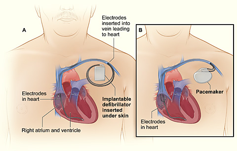 The image compares an ICD with a pacemaker. Figure A shows the location and general size of an ICD in the upper chest. The wires with electrodes on the ends are inserted into the heart through a vein in the upper chest. Figure B shows the location and general size of a pacemaker in the upper chest. The wires with electrodes on the ends are inserted into the heart through a vein in the upper chest.