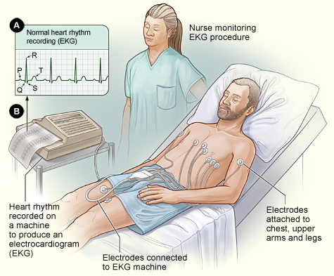 The picture shows the standard setup for an EKG. Figure A shows the data from the EKG, which are mapped on a graph. In figure B, a patient lies in bed with EKG electrodes attached to his chest, upper arms, and legs. A nurse oversees the painless procedure.