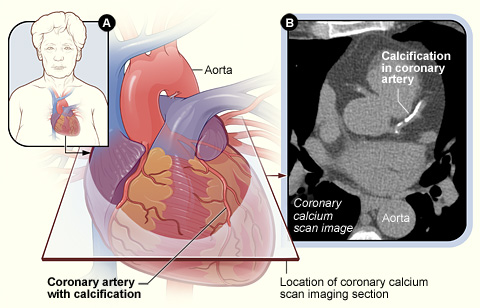 Figure A shows the position of the heart in the body and the location and angle of the coronary calcium scan image. Figure B is a coronary calcium scan image showing calcifications in a coronary artery.