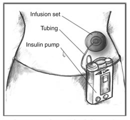 Drawing of female torso with an insulin pump and infusion set. The pump has buttons and a screen and is clipped to the woman's skirt. Narrow tubing connects the insulin pump to the infusion set attached to the abdomen. The infusion set has a round adhesive patch on the skin covering a cannula inserted under the skin. The infusion set, tubing, and insulin pump are labeled.
