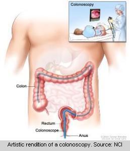 Colonoscopy; shows colonoscope inserted through the anus and rectum and into the colon. Inset shows patient on table having a colonoscopy. 