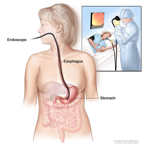 Upper endoscopy; shows endoscope inserted through the mouth and esophagus and into the stomach. Inset shows patient on table having an upper endoscopy.