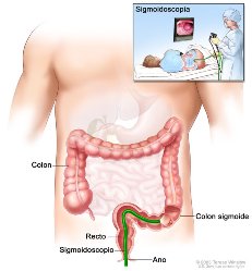 Imagen muestra un sigmoidoscopio insertado por el ano y recto dentro del colon sigmoide. Recuadro muestra al paciente en la mesa al hacerse una sigmoidoscopia.