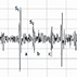 Audible Pericarditis