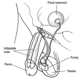 Drawing of an inflatable penile implant to treat erectile dysfunction. An erection is produced by squeezing a small pump implanted in the scrotum. The pump causes fluid to flow from a reservoir in the lower pelvis to two inflatable rods in the penis. The rods expand to create the erection. Labels point to the fluid reservoir, inflatable rods, penis, pump, and testes.
