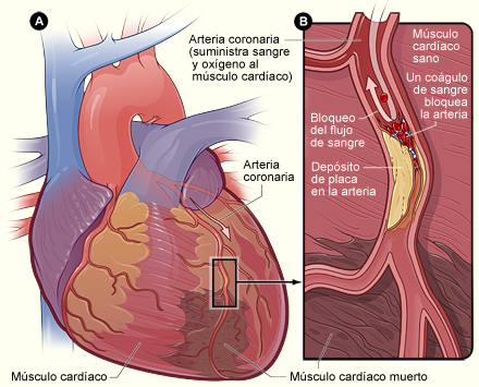 La figura A muestra un corazón con músculo cardíaco muerto a causa de un ataque cardíaco. La figura B es un corte transversal de una arteria coronaria con depósito de placa y un coágulo de sangre.