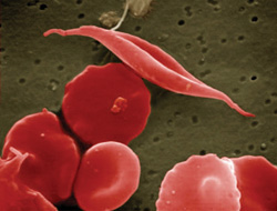 image of sickled cells and normal red blood cells