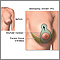 Elevación de mamas (mastopexia) - Serie