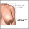 Reducción de mamas (mamoplastia) - Serie