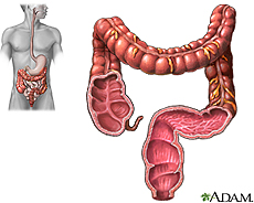 Illustration of the large intestine