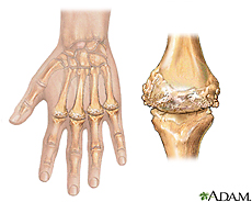 Ilustración de artritis reumatoide
