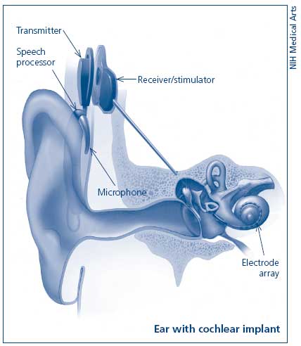 Illustration of cochlear implant.