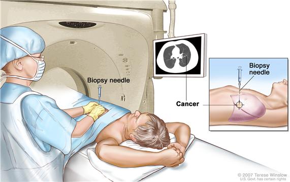 Lung biopsy; drawing shows a patient lying on a table that slides through the computed tomography (CT) machine with an x-ray picture of a cross-section of the lung on a monitor above the patient. Drawing also shows a doctor using the x-ray picture to help place the biopsy needle through the chest wall and into the area of abnormal lung tissue. Inset shows a side view of the chest cavity and lungs with the biopsy needle inserted into the area of abnormal tissue.