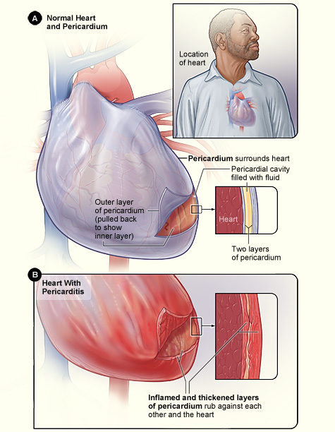 Figure A shows the location of the heart and a normal heart and pericardium (the sac surrounding the heart). The inset image is an enlarged cross-section of the pericardium that shows its two layers of tissue and the fluid between the layers. Figure B shows the heart with pericarditis. The inset image is an enlarged cross-section that shows the inflamed and thickened layers of the pericardium.