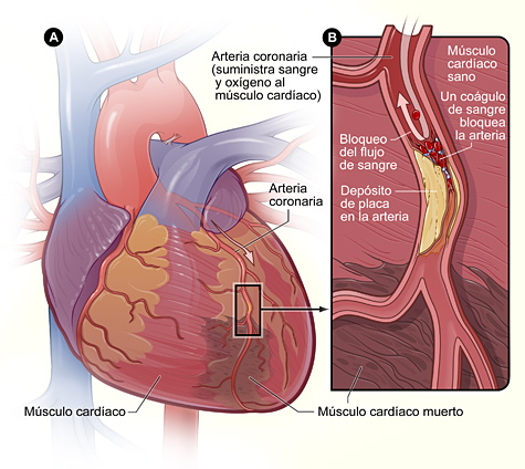 La figura A es el esquema de un corazón y de una arteria coronaria que están lesionados (músculo cardíaco muerto) a causa de un ataque cardíaco. La figura B es un corte transversal de la arteria coronaria con depósito de placa y con un coágulo de sangre que se formó a causa de la ruptura de la placa.