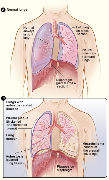 Figure A shows the location of the lungs, airways, pleura, and diaphragm in the body. Figure B shows lungs with asbestos-related diseases, including pleural plaque, lung cancer, asbestosis, plaque on the diaphragm, and mesothelioma. 