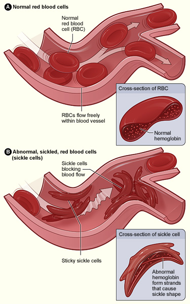 Figure A shows normal red blood cells flowing freely in a blood vessel. The inset image shows a cross-section of a normal red blood cell with normal hemoglobin. Figure B shows abnormal, sickled red blood cells blocking blood flow in a blood vessel. The inset image shows a cross-section of a sickle cell with abnormal (sickle) hemoglobin forming abnormal strands.