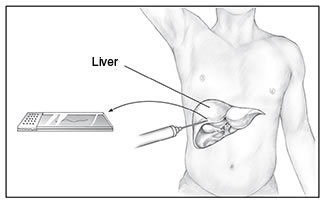 Drawing of a liver biopsy procedure. A liver is drawn within an outline of a male body. A needle pricks a piece of the liver tissue. An arrow points away from the spot where the needle touches the liver toward a slide with the tissue sample. The liver is labeled.