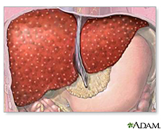 Illustration of cirrhosis of the liver