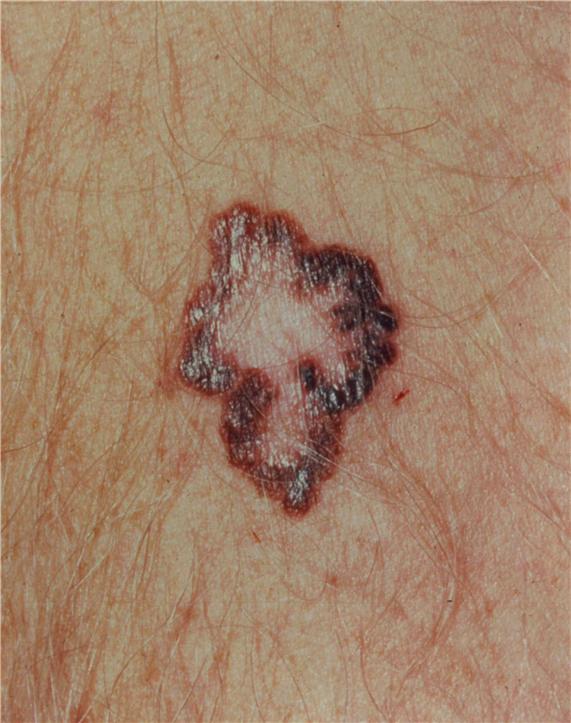 Photograph of a brown lesion with a large and irregular border on the skin.