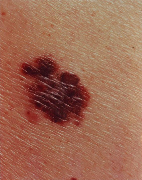 Photograph of a large, asymmetrical, red and brown lesion on the skin.
