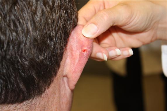 Photograph of a red, ulcerated lesion surrounded by a white border on the skin of the right ear.