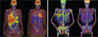 Before and after images of two patients treated for 2 weeks with vemurafenib (Images courtesy of Plexxikon)