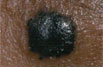Photo of a skin cancer that looks like a dark, waxy bump.